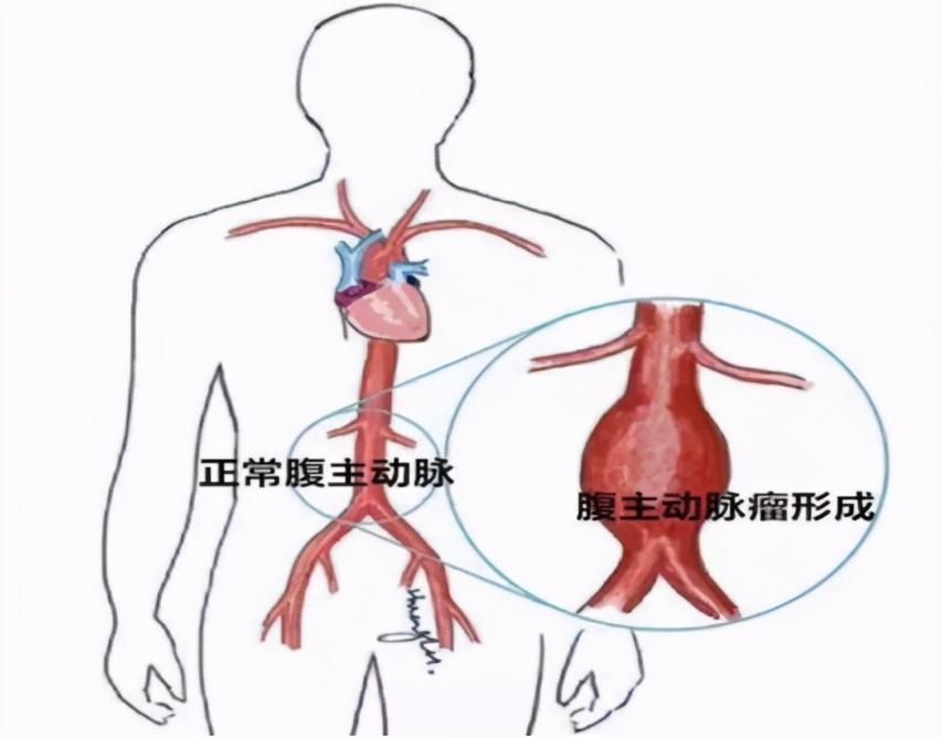 最新血管堵塞治疗方法的研究与应用